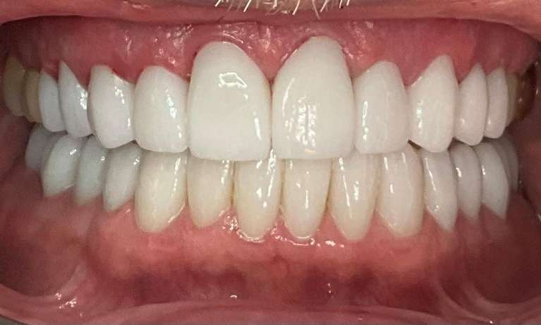 Full-Mouth-Rehabilitation-After-Image