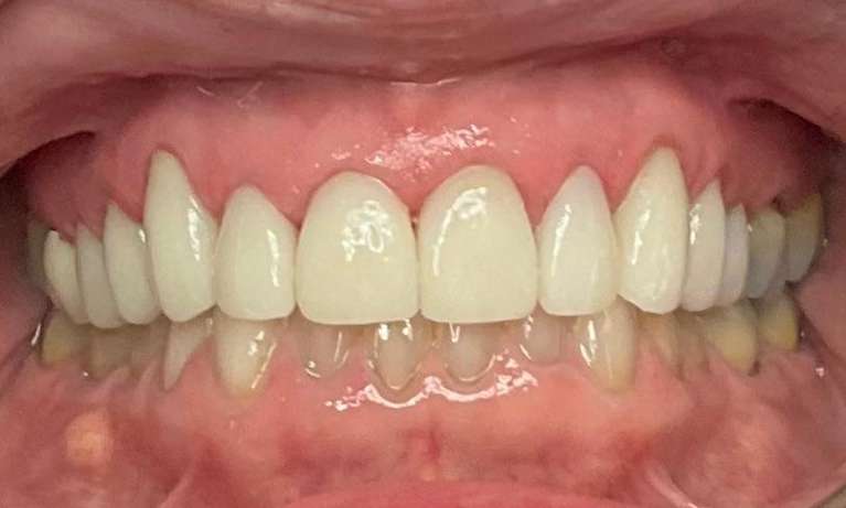 Smile-Makeover-After-Image