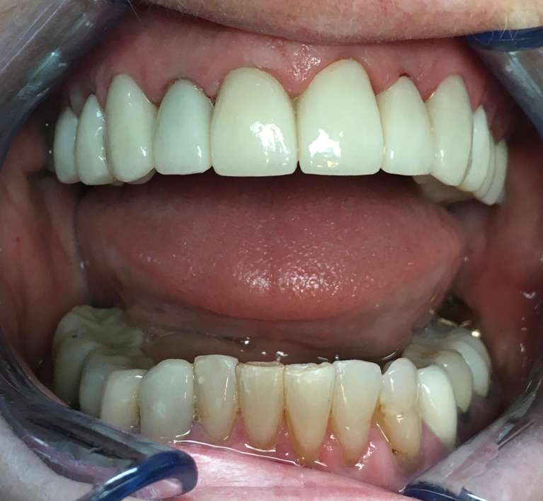 Smile-Makeover-After-Image