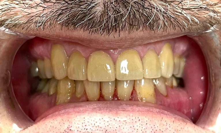 Smile-Makeover-After-Image