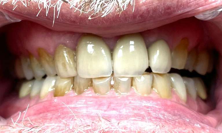 Full-Mouth-Rehabilitation-Before-Image