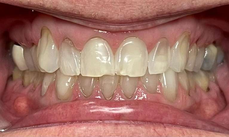 Smile-Makeover-Before-Image