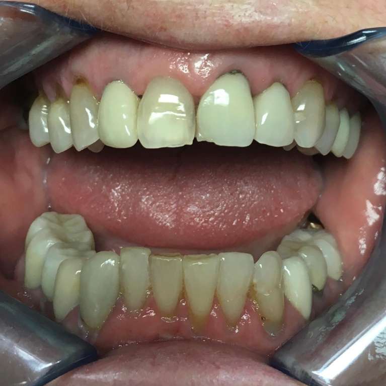 Smile-Makeover-Before-Image