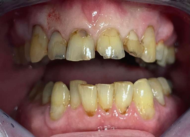 Smile-Makeover-Before-Image